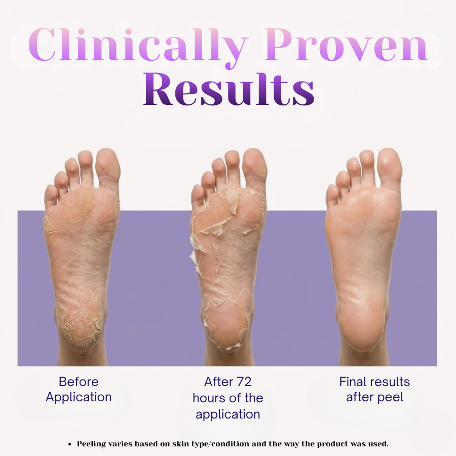 Korean Peeling & Exfoliating Foot Mask For Dry, Cracked Heels & Calluses with Glycolic, 2%Salicylic & Lactic Acids | Dead Skin & Callus Remover for Baby-Soft Skin Baby Soft Feet Treatment for Men & Women